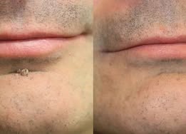 ✨2-in-1 Microneedle & Hydrocolloid Patch🍀| Removes Raised Moles, Acne, Flat Warts & Skin Tags | Helps Improve Wrinkles, Scars & Blemishes | Invisible Patches for Face & Body-YH