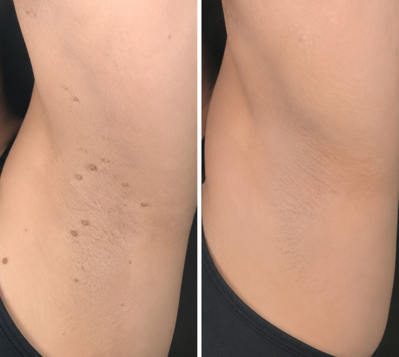 ✨2-in-1 Microneedle & Hydrocolloid Patch🍀| Removes Raised Moles, Acne, Flat Warts & Skin Tags | Helps Improve Wrinkles, Scars & Blemishes | Invisible Patches for Face & Body-YH