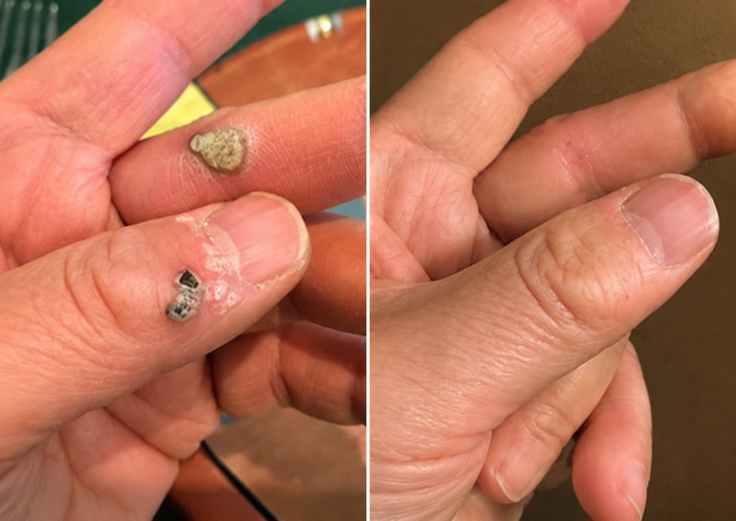 ✨2-in-1 Microneedle & Hydrocolloid Patch🍀| Removes Raised Moles, Acne, Flat Warts & Skin Tags | Helps Improve Wrinkles, Scars & Blemishes | Invisible Patches for Face & Body-YH